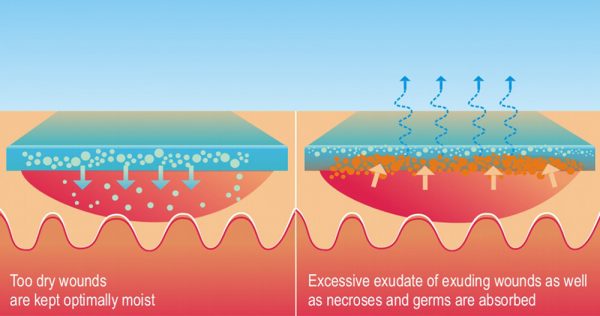 Neoheal. Sterile hydrogel dressings for moist wound management